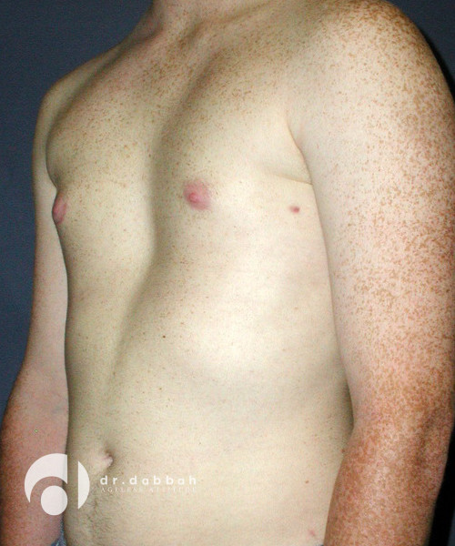 after gynecomastia left view male patient case 1812