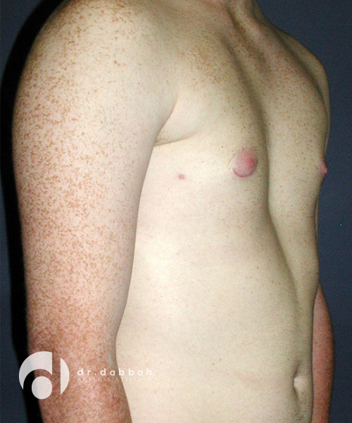 after gynecomastia right view male patient case 1812