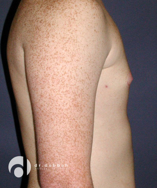 after gynecomastia right side view male patient case 1812