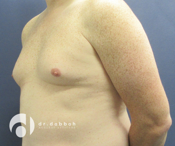before gynecomastia left view male patient case 2347