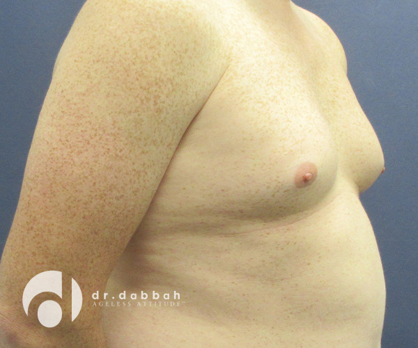 before gynecomastia right view male patient case 2347