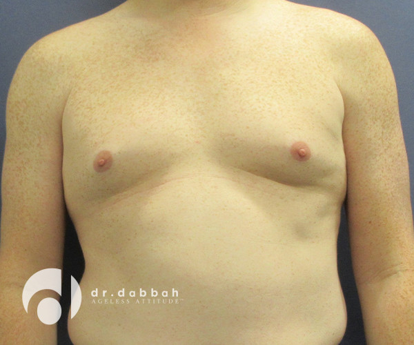 before gynecomastia front view male patient case 2347