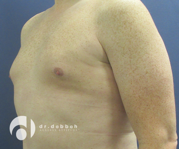 after gynecomastia left view male patient case 2347