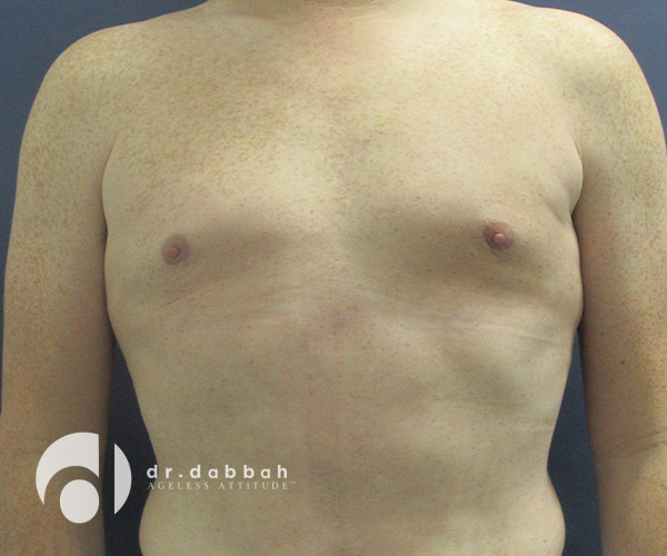 after gynecomastia front view male patient case 2347