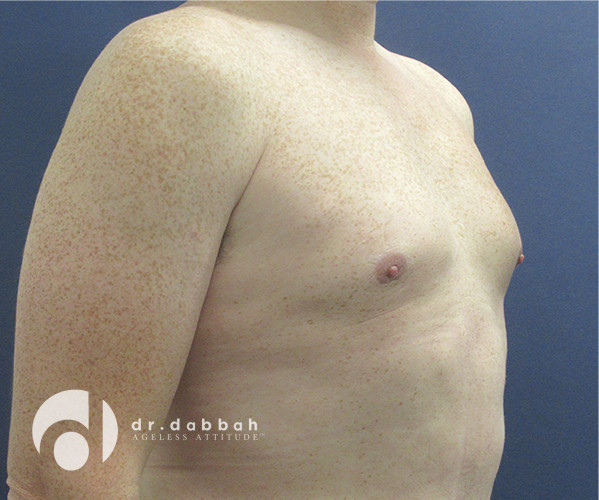 before gynecomastia right view male patient case 2347