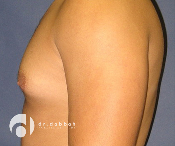 before gynecomastia left side view male patient case 2354