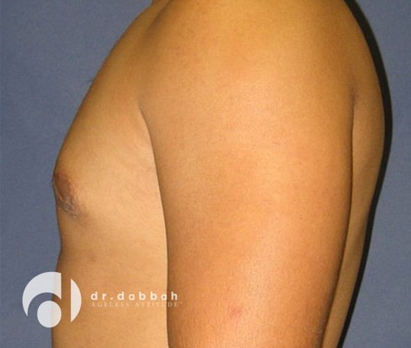 after gynecomastia left side view male patient case 2354