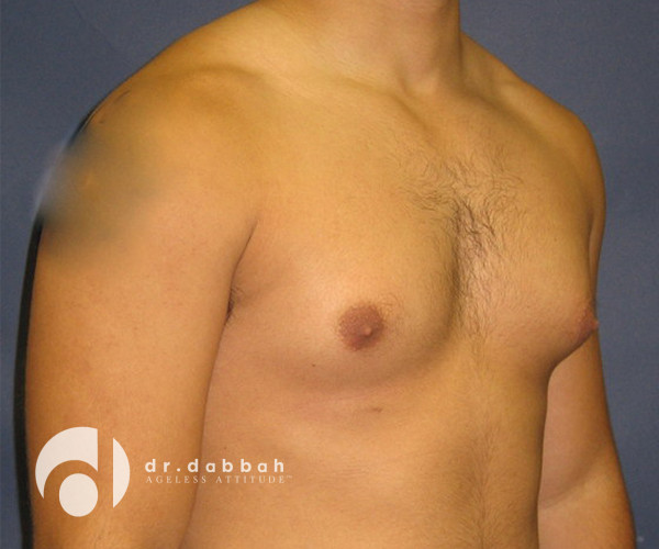 before gynecomastia right view male patient case 2354