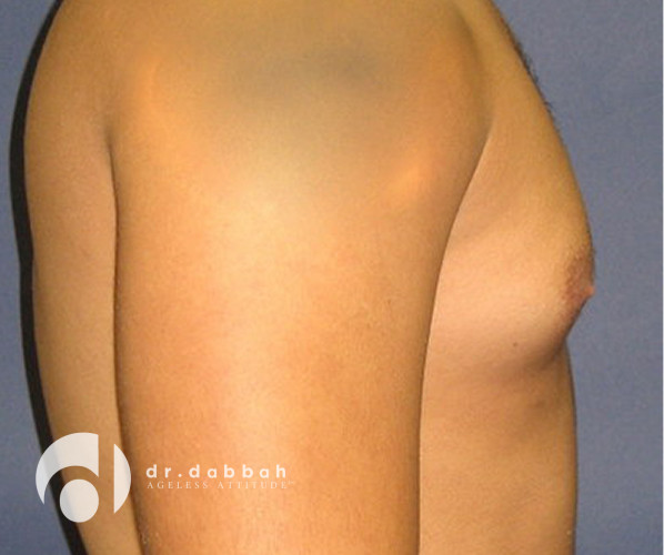 before gynecomastia right side view male patient case 2354