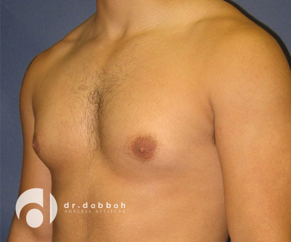 before gynecomastia left view male patient case 2354