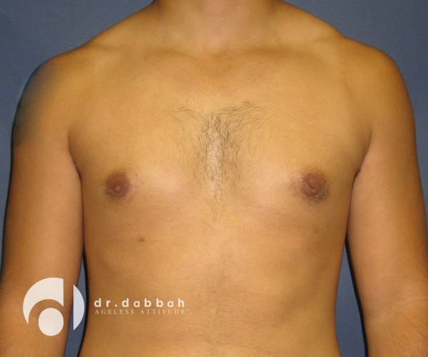after gynecomastia front view male patient case 2354