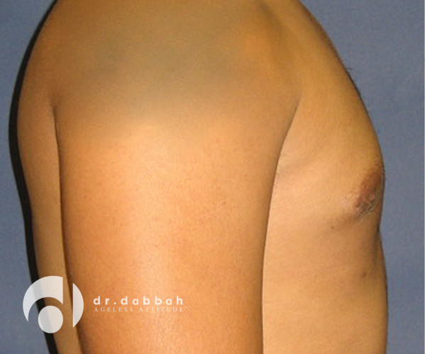 after gynecomastia right side view male patient case 2354
