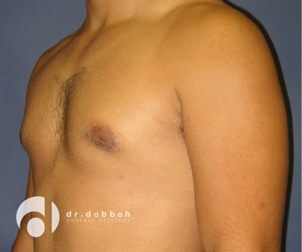 after gynecomastia left view male patient case 2354