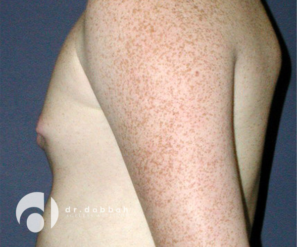 before gynecomastia left side view male patient case 2365