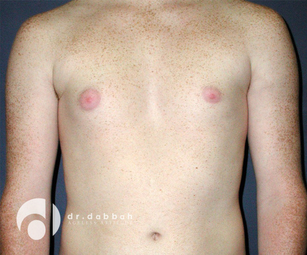 before gynecomastia front view male patient case 2365