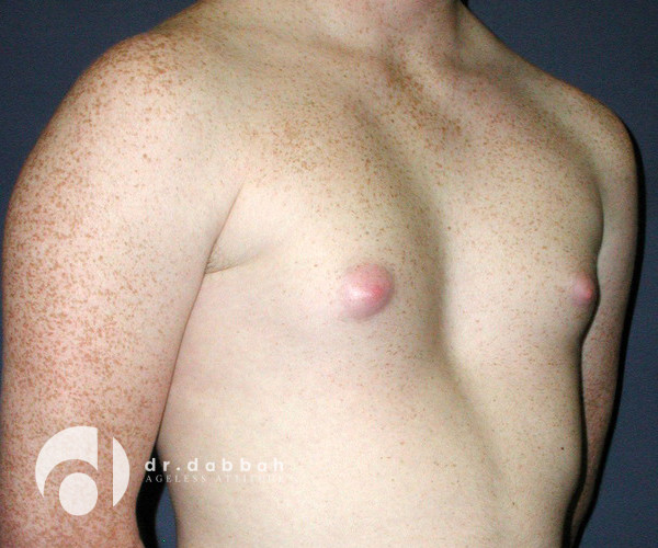 before gynecomastia right view male patient case 2365