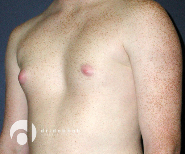 before gynecomastia left view male patient case 2365