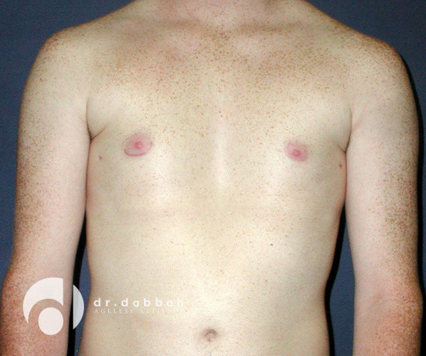 after gynecomastia front view male patient case 2365