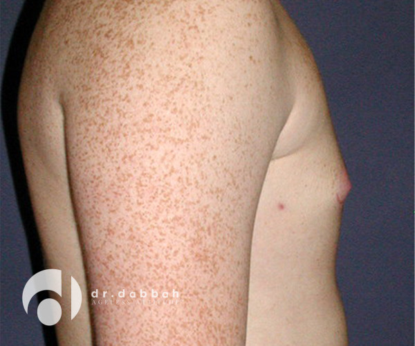 before gynecomastia right side view male patient case 2365