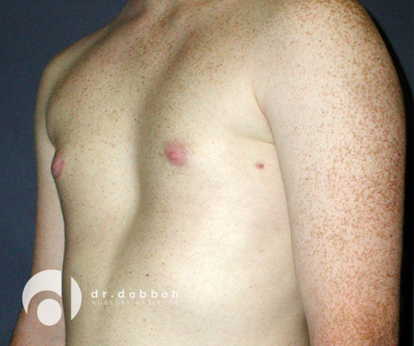after gynecomastia left view male patient case 2365