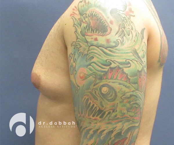 before gynecomastia left side view male patient case 2376