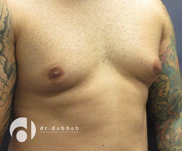 before gynecomastia right view male patient case 2376