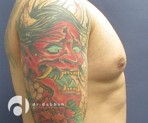 before gynecomastia right side view male patient case 2376