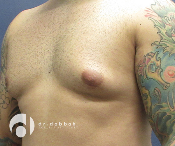 before gynecomastia left view male patient case 2376
