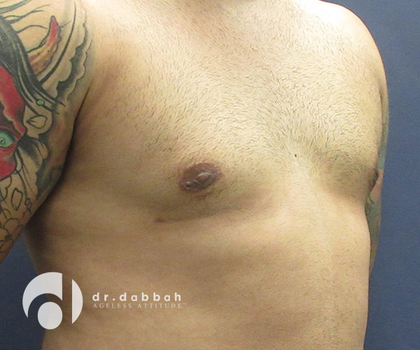 after gynecomastia right view male patient case 2376