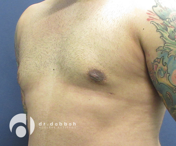 after gynecomastia left view male patient case 2376