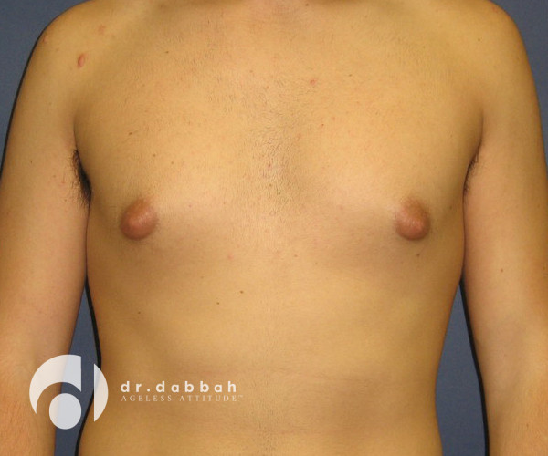 before gynecomastia front view male patient case 2387