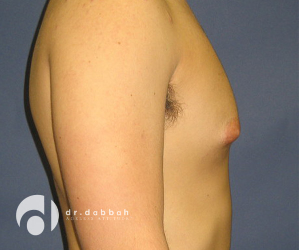 before gynecomastia right side view male patient case 2387