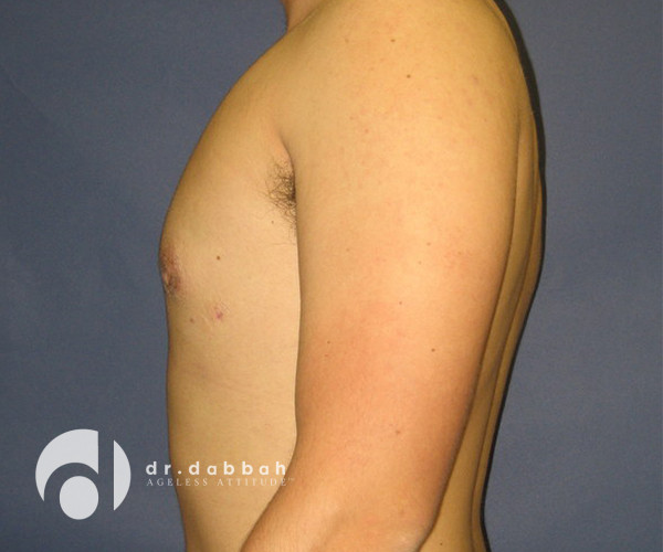 after gynecomastia left side view male patient case 2387