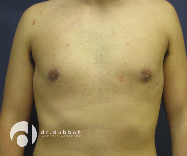 after gynecomastia front view male patient case 2387