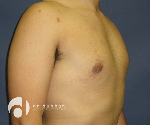 after gynecomastia right view male patient case 2387