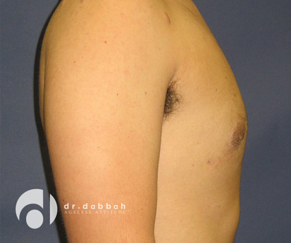 after gynecomastia right side view male patient case 2387