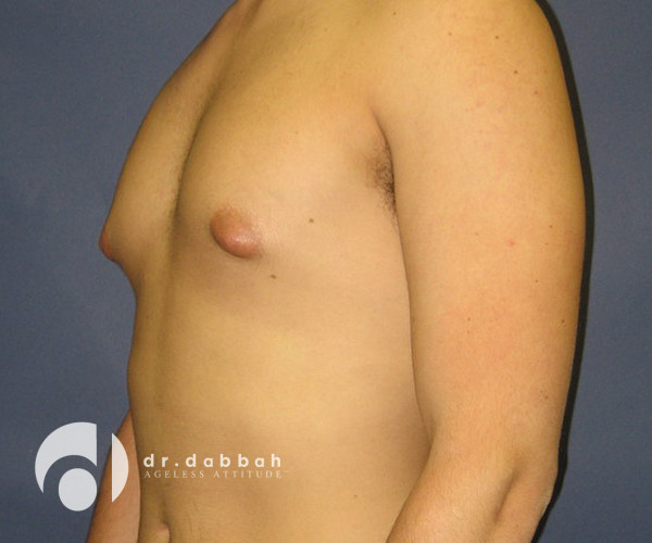before gynecomastia left view male patient case 2387