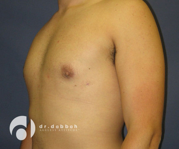 after gynecomastia left view male patient case 2387