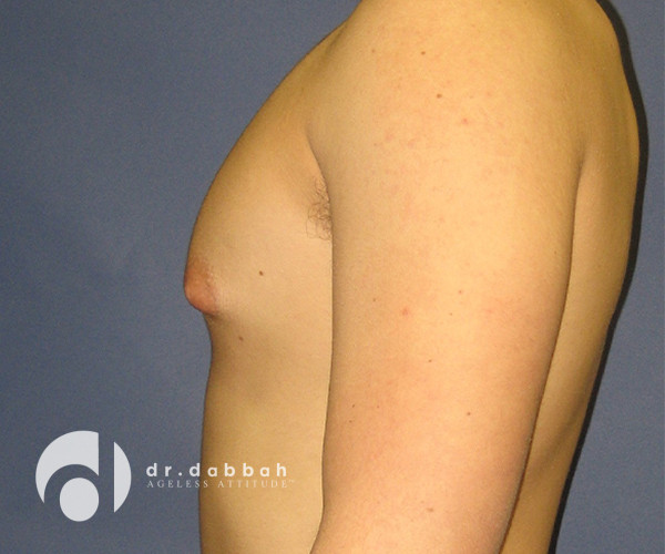 before gynecomastia left side view male patient case 2398