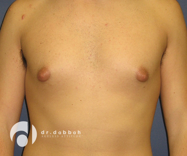 before gynecomastia front view male patient case 2398
