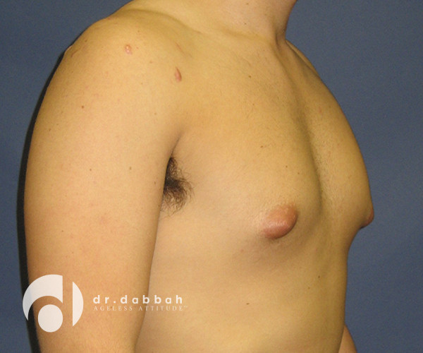 before gynecomastia right view male patient case 2398