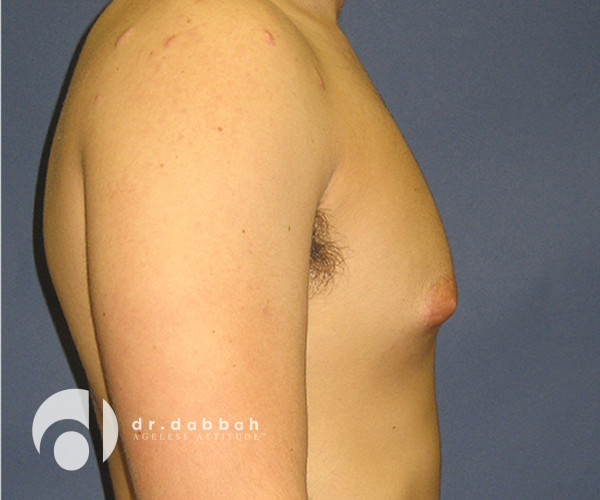 before gynecomastia right side view male patient case 2398