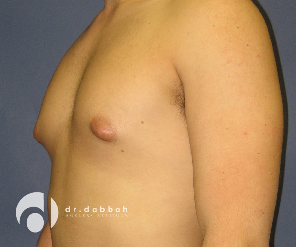 before gynecomastia left view male patient case 2398