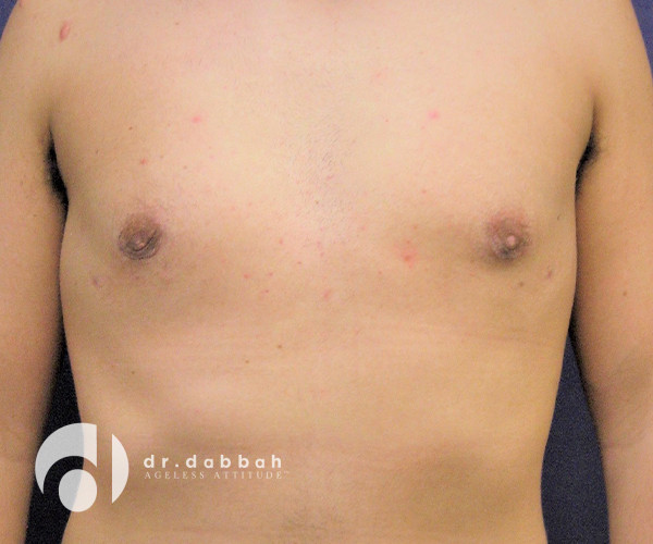 after gynecomastia front view male patient case 2398