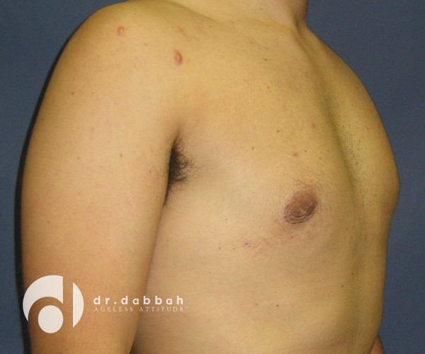 before gynecomastia right view male patient case 2398