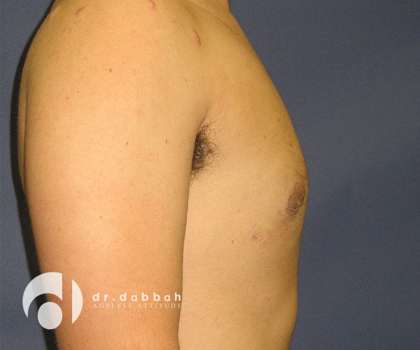 after gynecomastia right side view male patient case 2398