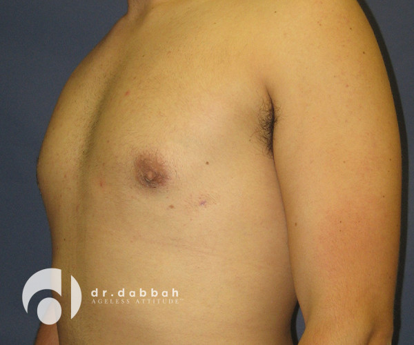 before gynecomastia left view male patient case 2398