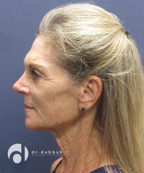 before neck lift surgery female patient left side view case 2426