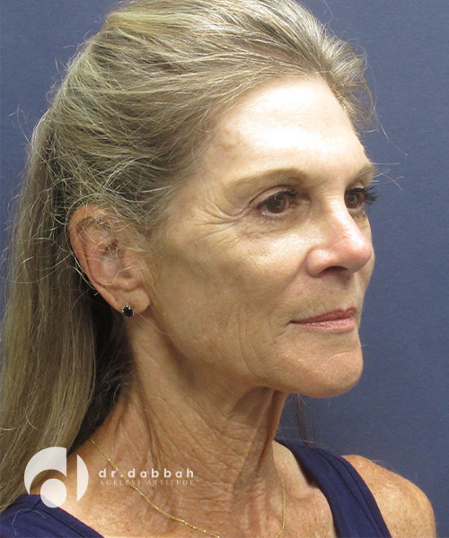 before neck lift surgery female patient right angled view case 2426
