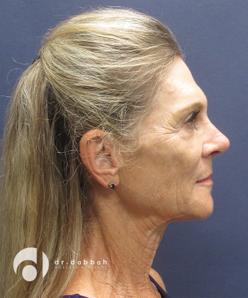 before neck lift surgery female patient right side view case 2426